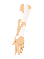 LeucodermaVitiligo