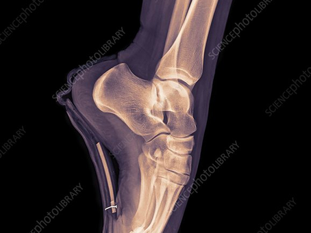 Foot And Ankle Injuries In Dance