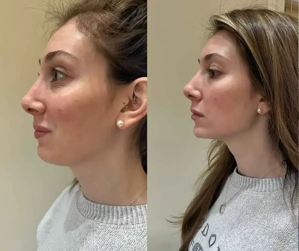 Jawline Filler Before and After: Photos, Cost, Results - Dr. Kopelman
