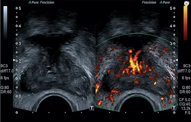 Muestra de tejido prostático con aguja guiada por ultrasonido para detectar cáncer u otras patologías.