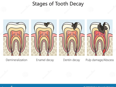 Understanding Cavities: Simple Prevention and Modern Solutions in Midtown Toronto