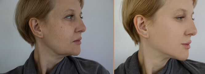 Refirme Before and After