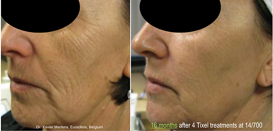Better Med Spa & Wellness - Tixel Before & After.png