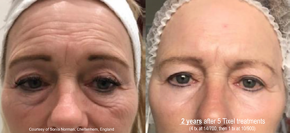 Better Med Spa & Wellness - Tixel Before & After.png