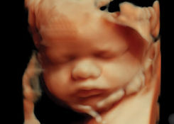 3D fetal image 