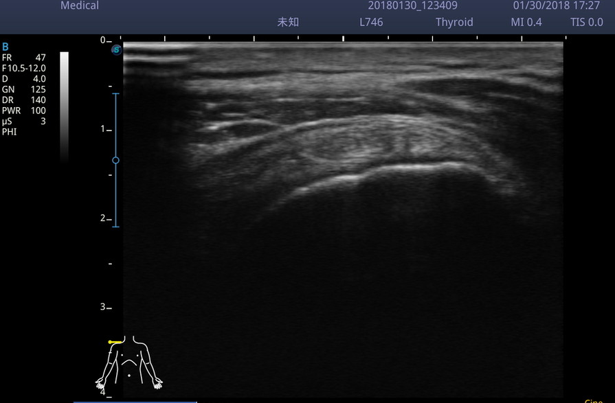 14. Supraspinatus.bmp