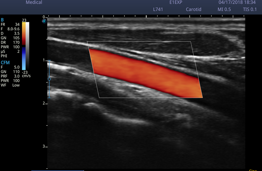 carotid artery_color.bmp