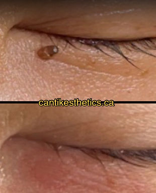 non-invasive skin lesion removal Surrey Cantik Esthetics Skin Care clinic