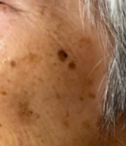 Brown spot removal Surrey BC