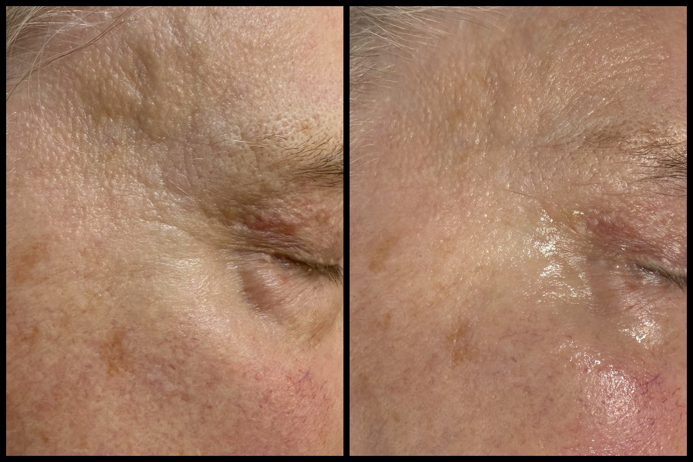 Before and after The Cantik Elixir Infusion ultrasound facial, Cantik Esthetics Surrey