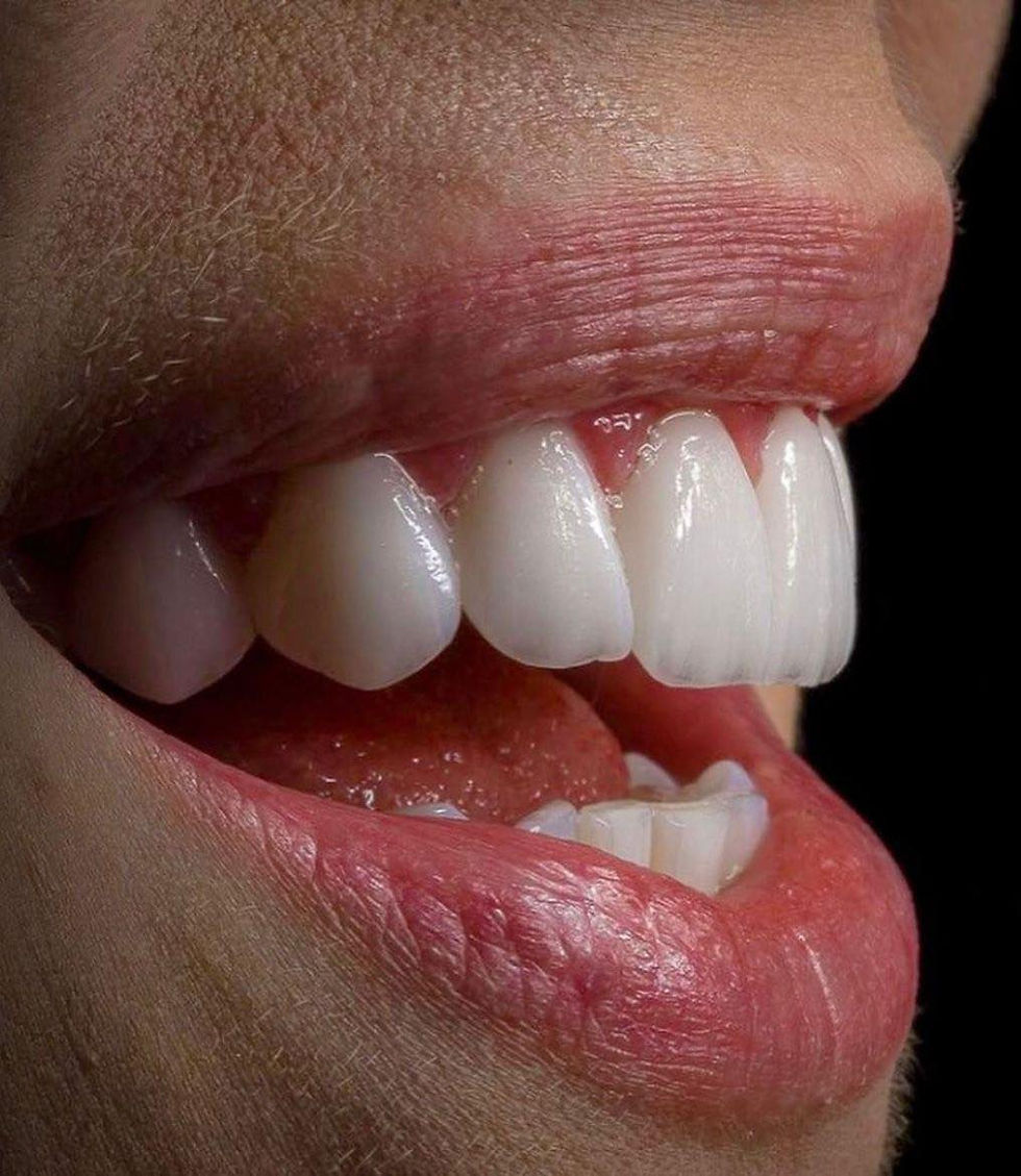 כתרי איימקס emax בטורקיה