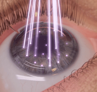 lasik