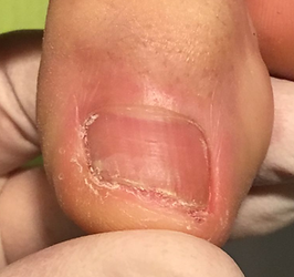 onicomicosi3 studio di palma Lodi.png