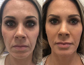 juvederm-restylane-47-front-thumbnail