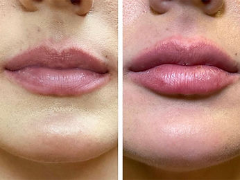 Before-After-Lip-Augmentation-Dermal-Fillers-3