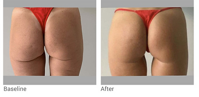 Endolift-Before-and-after-Well-Medical-Arts-Seattle-Butt-lift-2_edited