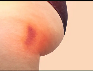 bblbruise.png