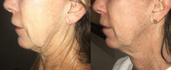 morpheus8-before-after-dr-f-roth-preview-2