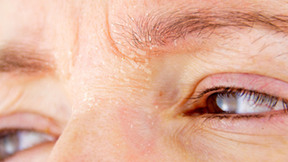 Pele vermelha no rosto: rosácea, dermatite seborreica ou alergia? Como diferenciar