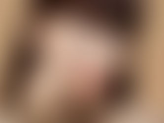 Melasma: por que ele volta e como controlar sem radicalismos
