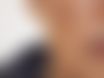 Melasma: Causas, Tratamentos e Prevenção