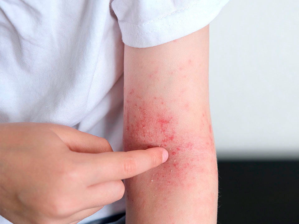 Braço com erupção cutânea avermelhada. Uma mão aponta para a área irritada. Pessoa usa camisa branca em fundo neutro.