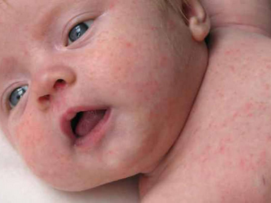 Dermatite Atópica: Por Que Sua Pele Coça Tanto e Como Recuperar o Controle