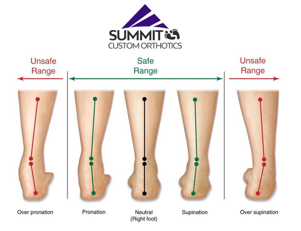 5 Benefits of Custom Foot Orthotics