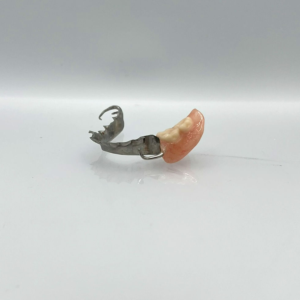 Metal partial denture with 2 teeth