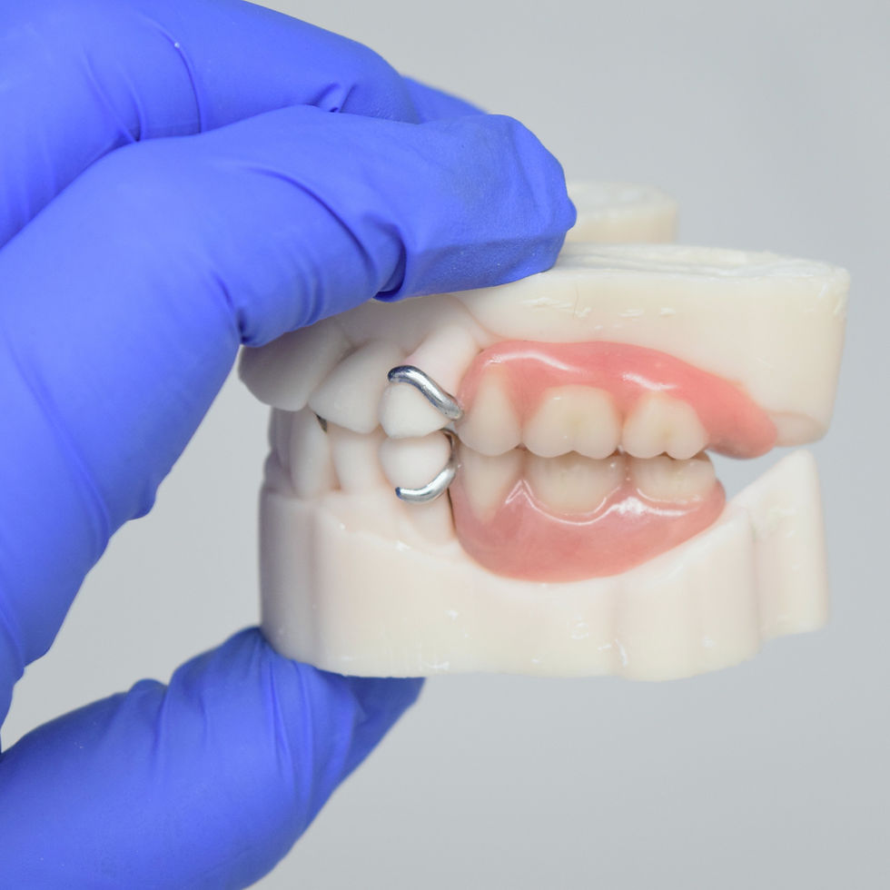 Upper and lower metal partial dentures restoring posterior teeth