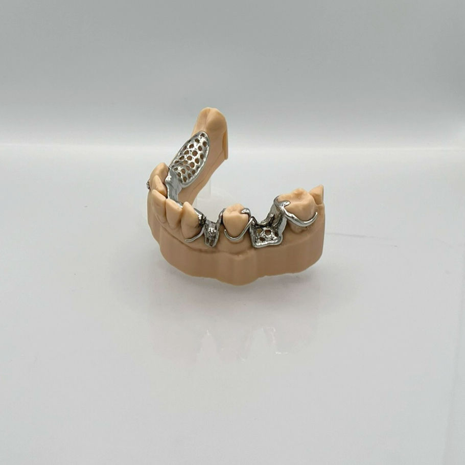 Metal partial denture (framework only)