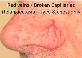 Telangiectasia.png
