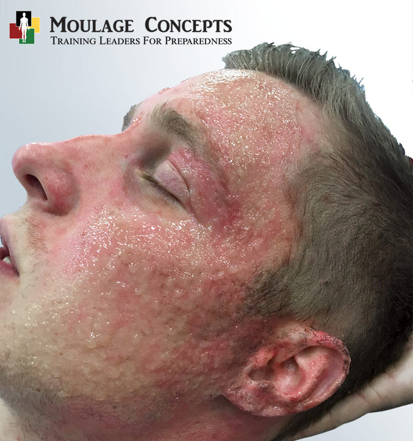 blast_burn_moulage_concepts
