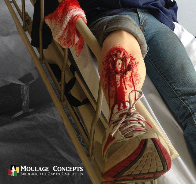 Open-compound fracture