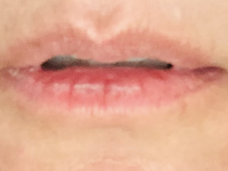  Why Do Some Older Adults With HEDS Suffer from Splitting Lips, Heels, and Cuticles?