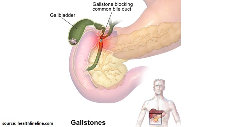 Causes of Gallbladder Stones