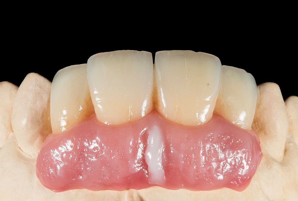 תמונה ממוזערת: מכחול לג'ינג'יבה -Brush Module for gingiva