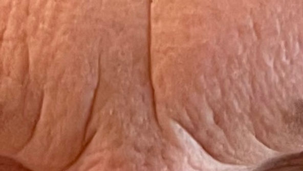 Glabella ("elevens")