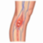 Deep Vein Thrombosis (DVT) illustration by Pyllola