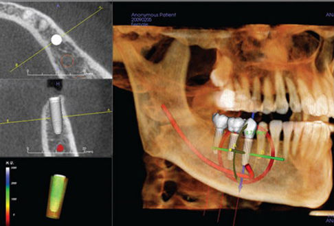 bone graft image.jpeg
