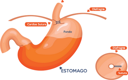reflujo (1).png