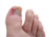 ingrown toe nail.jpeg