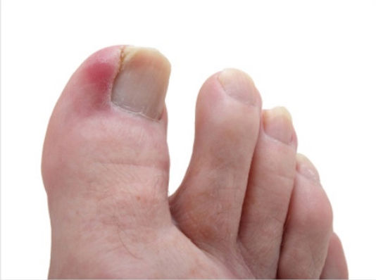 ingrown toe nail.jpeg