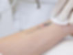 tattoo removal laser