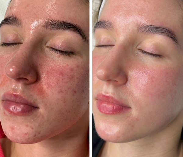 microneedling-london.png