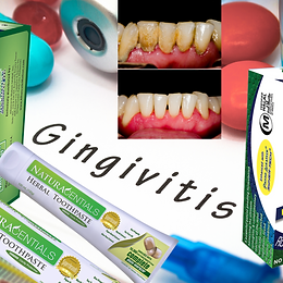 Gingivitis