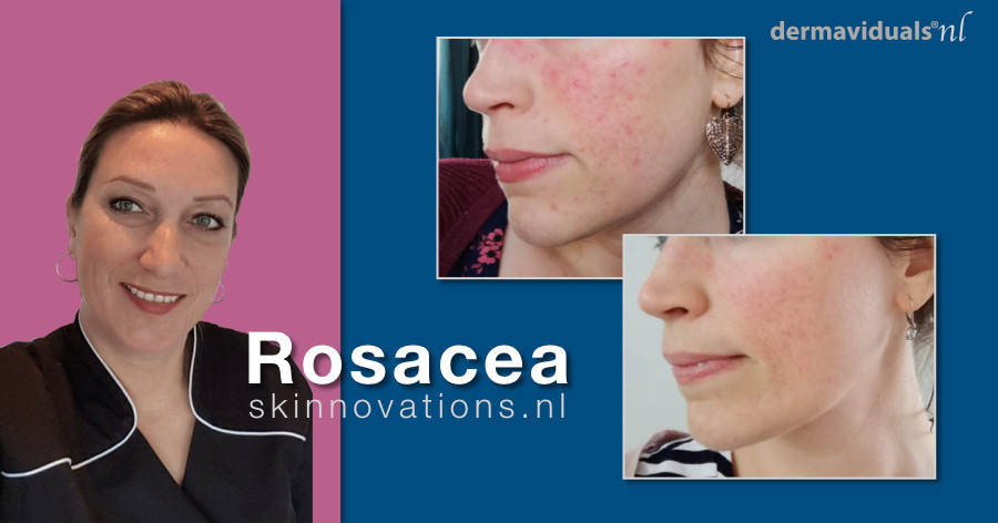 een huid met rosacea, rosacea behandeling, resultaat van een rosacea behandeling