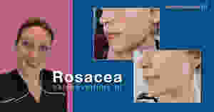 een huid met rosacea, rosacea behandeling, resultaat van een rosacea behandeling