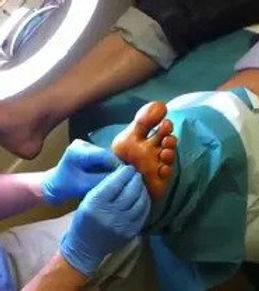 Surgical Verruca removal.jpg