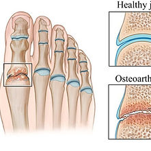 Navigating Big Toe Arthritis: Understanding 1st MTP Degeneration